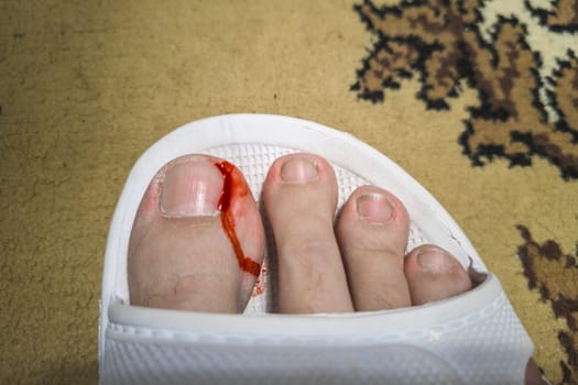 Close-up of a foot in a white plastic slipper with a bleeding toe caused by a torn hangnail. Medical theme highlighting injury, hygiene, and wound care.