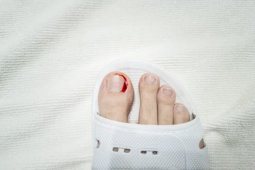 Close-up of a foot in a white plastic slipper with a bleeding toe caused by a torn hangnail. Medical theme highlighting injury, hygiene, and wound care.