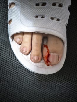 Close-up of a foot in a white plastic slipper with a bleeding toe caused by a torn hangnail. Medical theme highlighting injury, hygiene, and wound care.