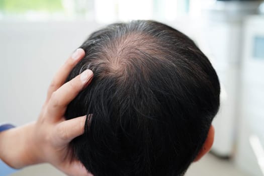 Bald head in man, hair loss treatment health problem.
