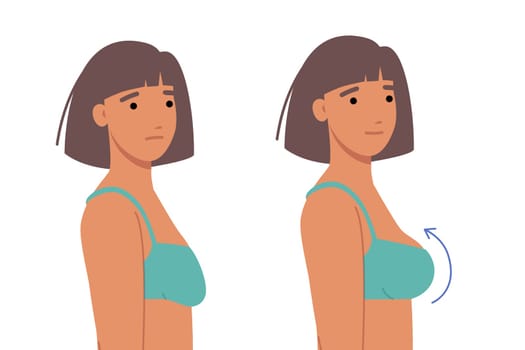 Woman had plastic surgery for breasts, inserting implants to increase size or improve firmness. Comparison of two girls before and after breast surgery and lifting of sagging nipples