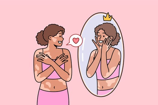 Woman with vitiligo syndrome or spots on skin looks in mirror and smiles, accepting herself as she is. Ethnic girl with high self-esteem and vitiligo disease feels sympathy for own reflection