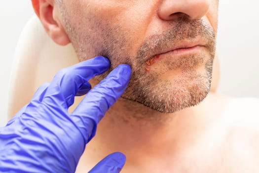 Doctor Examines Male's Lips Affected By Herpes In Focus. Painful Blisters Or Ulcers. Hsv Infection And Virus. Horizontal, Healthcare. Cropped Man's Face, Lips With Viral Infection. Medical Concept.