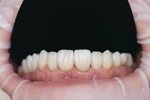 Closeup photo with zirconium artificial teeth. Zirconium crowns.