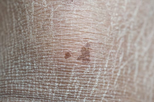 Skin surface displays detailed texture and small brown spots.