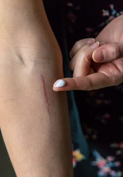 A scratch on a woman hand. Selective focus. people.