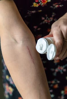 A scratch on a woman hand. Selective focus. people.