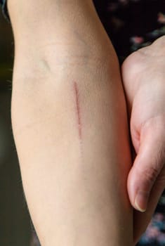A scratch on a woman hand. Selective focus. people.
