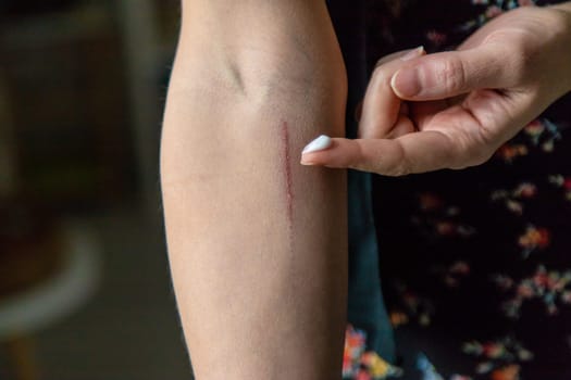 A scratch on a woman hand. Selective focus. people.