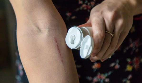 A scratch on a woman hand. Selective focus. people.