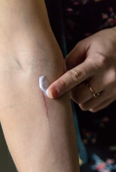 A scratch on a woman hand. Selective focus. people.