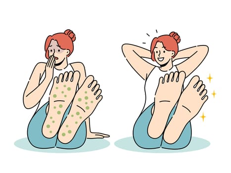 Woman with rash on feet suffers from allergies and fungal infection that causes severe itching and odor. Sad and happy girl before and after applying healing cream to fight fungus on feet