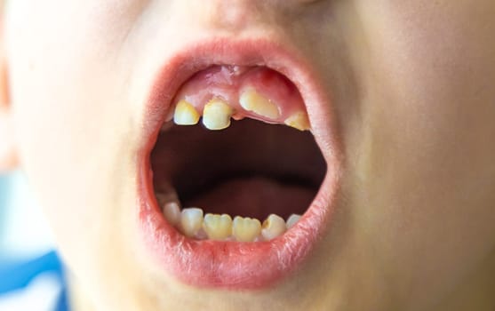 The child has bad teeth. Selective focus. Kid.