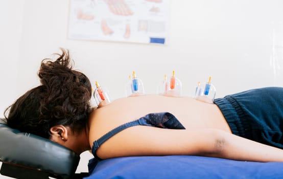 Acupuncture cupping on the back of a person lying down, Patient lying down with suction cups on her back. Physiotherapy cupping on a lying patient. Close-up of suction cups on the patient back