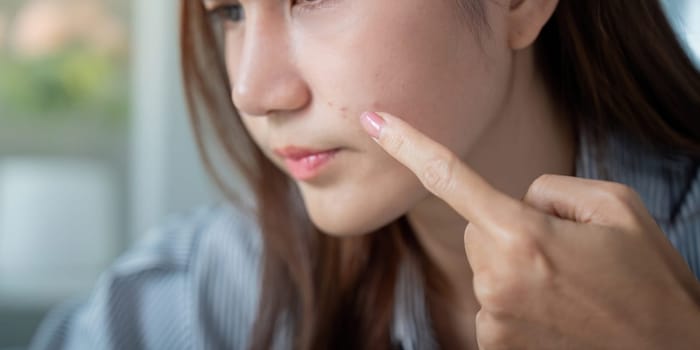 A woman points to a blemish on her face, reflecting on skin troubles and the challenges of maintaining clear skin.