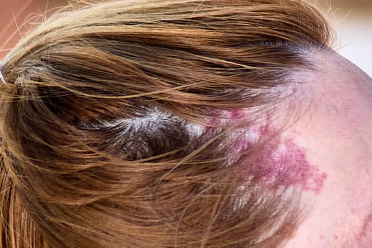 A birthmark located near the forehead on the scalp, partially covered by light brown hair. The reddish mark has an irregular shape and appears distinct on the skin beneath the hair, adding a personal and unique feature.
