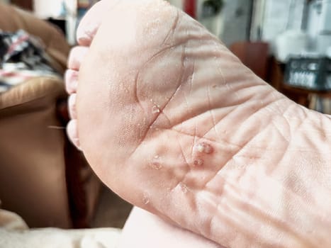 This close-up shows a foot affected by fungus, highlighting the texture and marks that indicate an infection, needing attention.