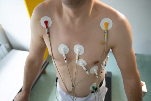 A middle-aged man is undergoing a medical stress test on a treadmill, connected to ECG electrodes for heart monitoring in a clinical environment.