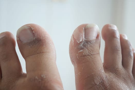 Close-up of dry and cracked toes highlighting health concerns and care.