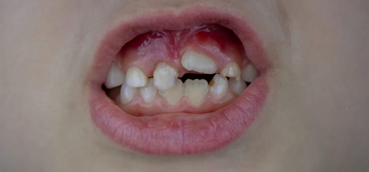 Close-up of unhealthy baby teeth. Sick teeth in a child. Portrait of a boy with sick teeth.