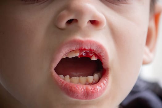 A child has lost a baby tooth. Kid.Concept baby tooth.
