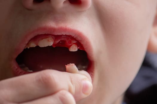 A child has lost a baby tooth. Kid.Concept baby tooth.