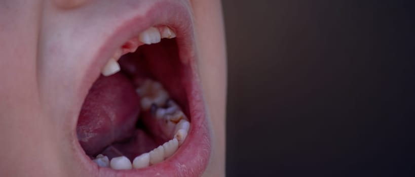 Close-up of unhealthy baby teeth. Sick teeth in a child. Portrait of a boy with sick teeth.