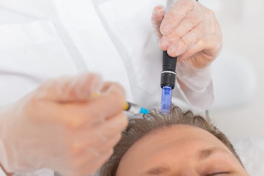 Alopecia. Man hair loss improve growth treatment regeneration, dermapen microneedling, vitamin exosomes plasma injections. Trichologist cosmetologist doctor head scalp procedure fractional mesotherapy
