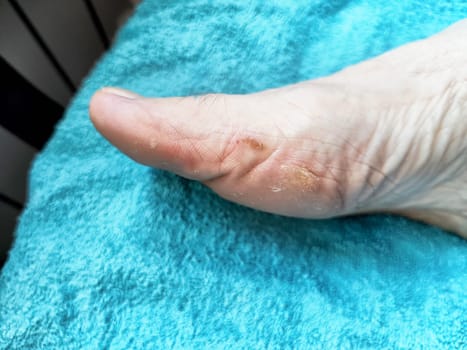 A close-up view of a toe affected by foot fungus resting on a soft blue towel. The person appears to be indoors and relaxed.