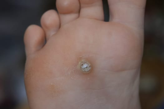 Plantar wart on a child's foot. Papillomavirus Wart verrucas plantar.