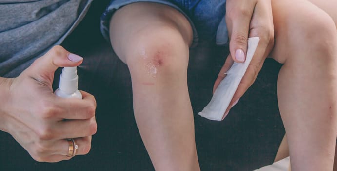 Scratches on a child's leg. small child