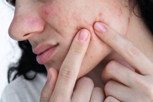 young woman presses acne and pimples on skin on face with fingers. Girl with problematic skin close-up on white background