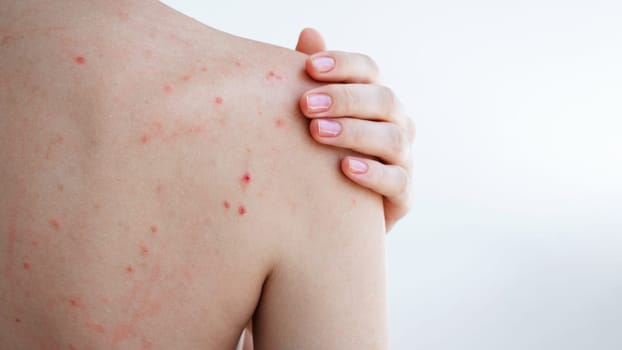 female back and shoulders of woman with pimples and acne on skin on a white isolated background. The body of a girl with problematic skin close-up