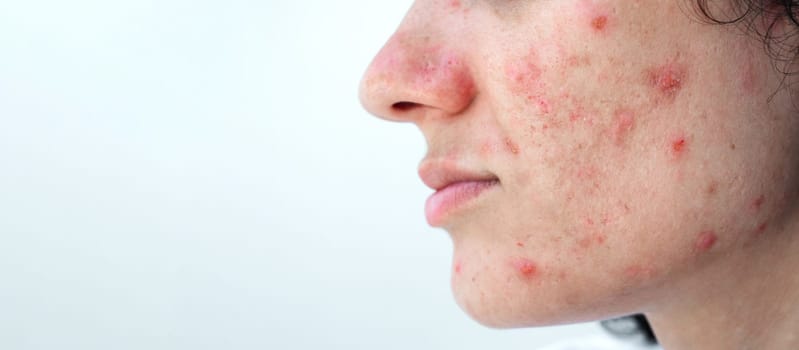 female face of a young woman with acne and pimples on skin with problem close-up on isolated white background