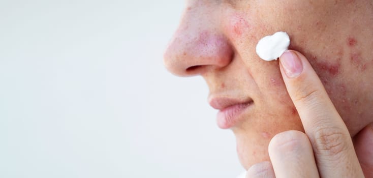 young woman applies acne cream on female face with pimples. Girl with problematic skin in closeup on an isolated white background