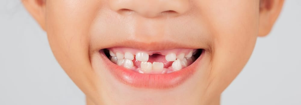 A happy child with a missing tooth smiles brightly. The dentist educates on tooth loss, helping parents understand the natural stages of baby teeth falling out. closeup