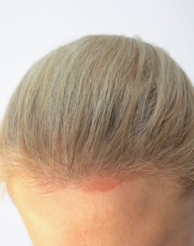 Cropped Caucasian Female Face with Sunburn Skin On Scalp, Forehead Under Hair, White Background. White Woman Suffers From Face Sun Burn. UV Danger. Vertical Plane.