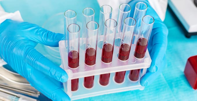 examine blood in the laboratory. Selective focus. medicine.