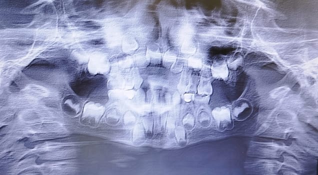 A panoramic dental x-ray reveals a child's teeth and jaw structure. Primary and permanent teeth are visible, showing dental development and potential orthodontic concerns.