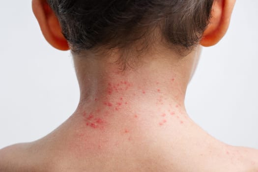 Chicken pox rash spots on child skin close-up. Coxsackie virus on the boy neck