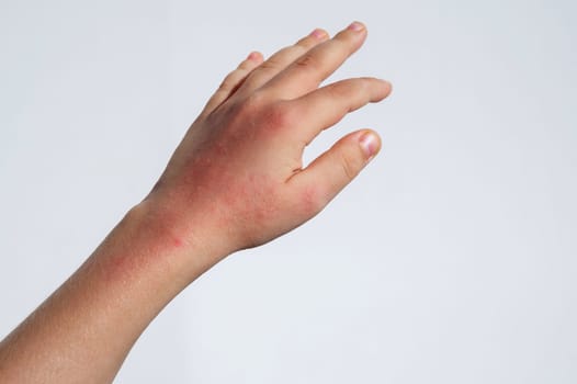 Chicken pox red rash spots on child skin close-up. Coxsackie virus on the hand of baby