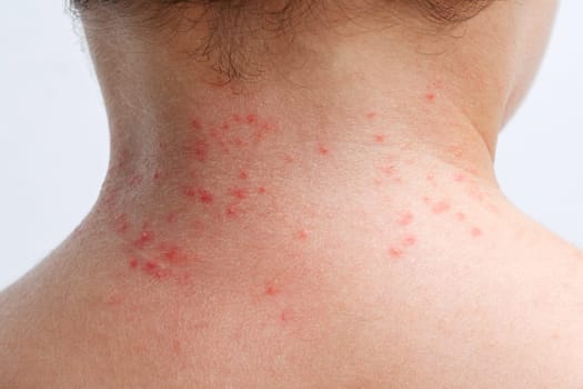 Red rashes from the Coxsackie virus on a child back. Chicken pox allergy symptoms on skin on children's body close up