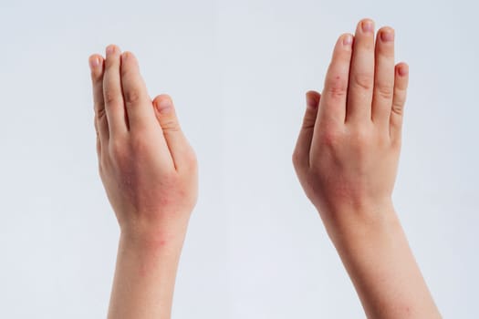 Red rashes from Coxsackie virus on a child hands on a white background. Chickenpox allergy symptoms on children's skin close-up