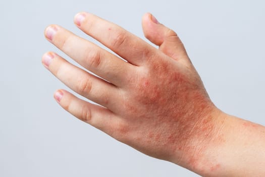 Red rashes spots from Coxsackie virus on child hand close-up. Chicken pox and allergy symptoms on skin on children's body on a white background