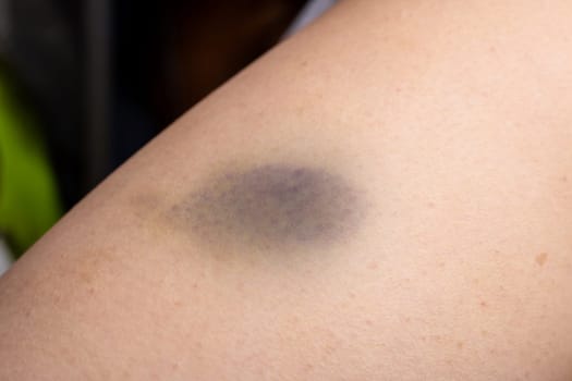 A close up of a person s arm with a purple spot on it