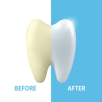 Vector Banner with 3d Realistic Tooth Closeup. Cleaning Concept - Before and After Hygienic Teeth Cleaning. Dentistry Design. Medical, Toothpaste Advertisement. Healthy Oral Hygiene, Teeth Whitening.