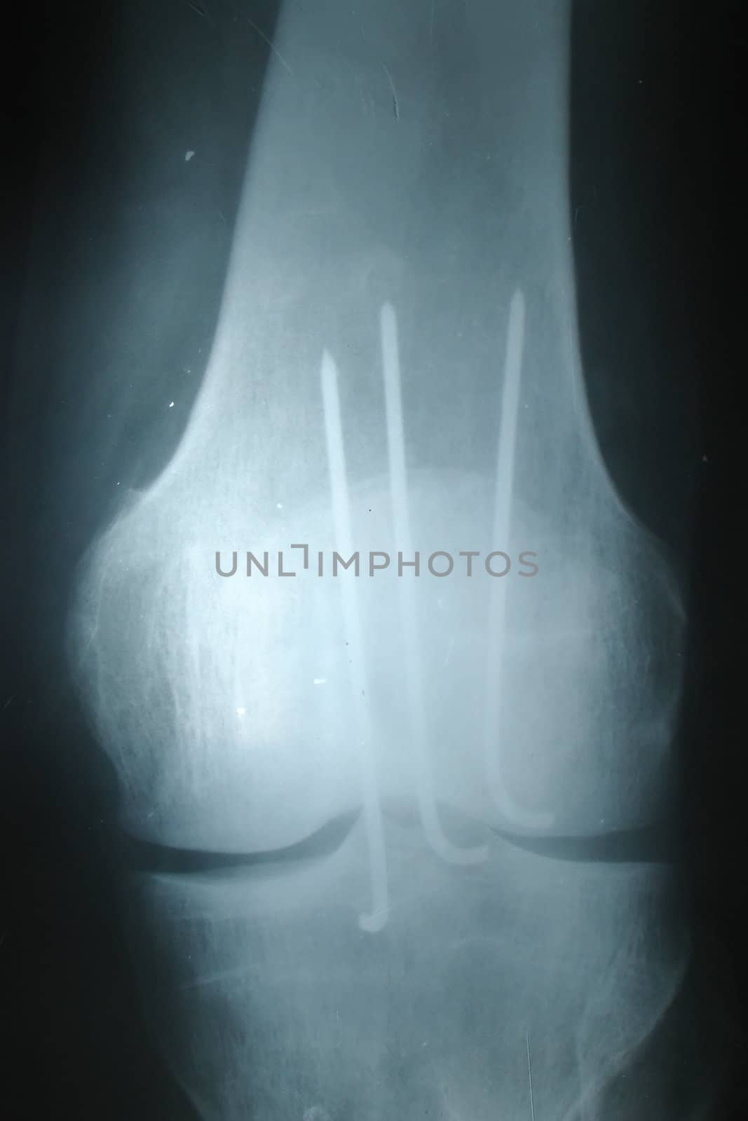 Knee joint x-ray fromt image                             