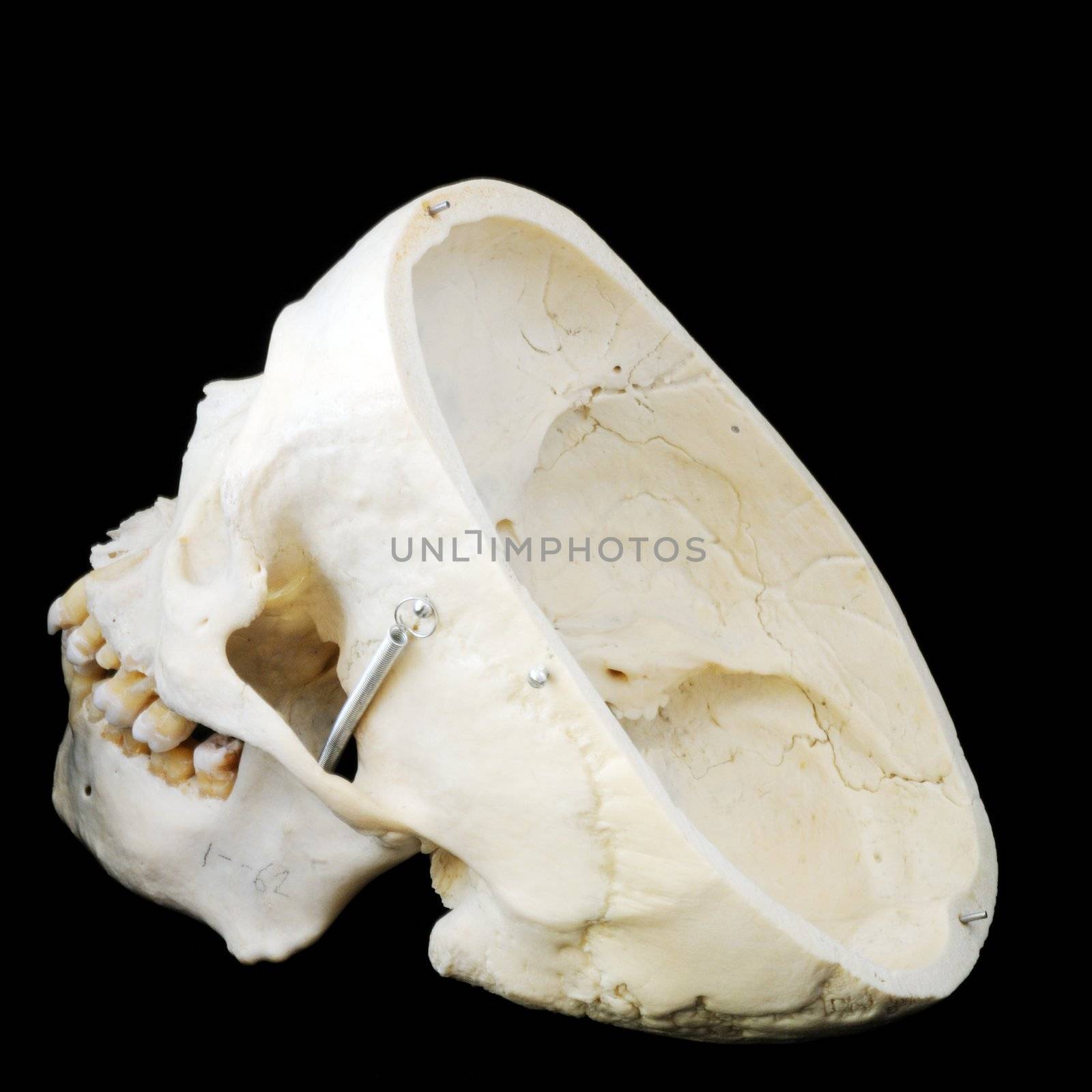 A real human skull with the cap cut away to show the interior of the brain case.