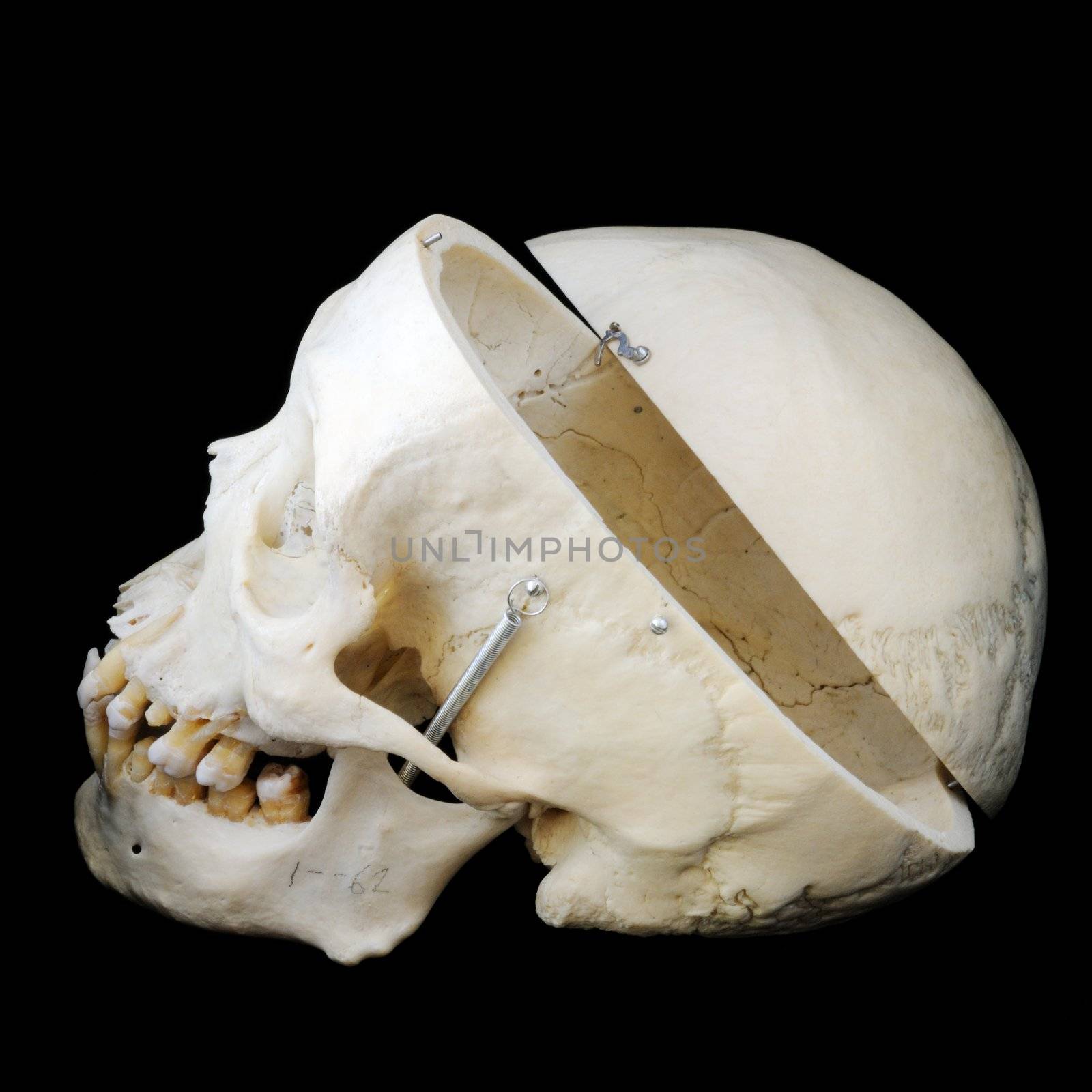 A real human skull with the cap cut away to show the interior of the brain case.  Side view with cap.