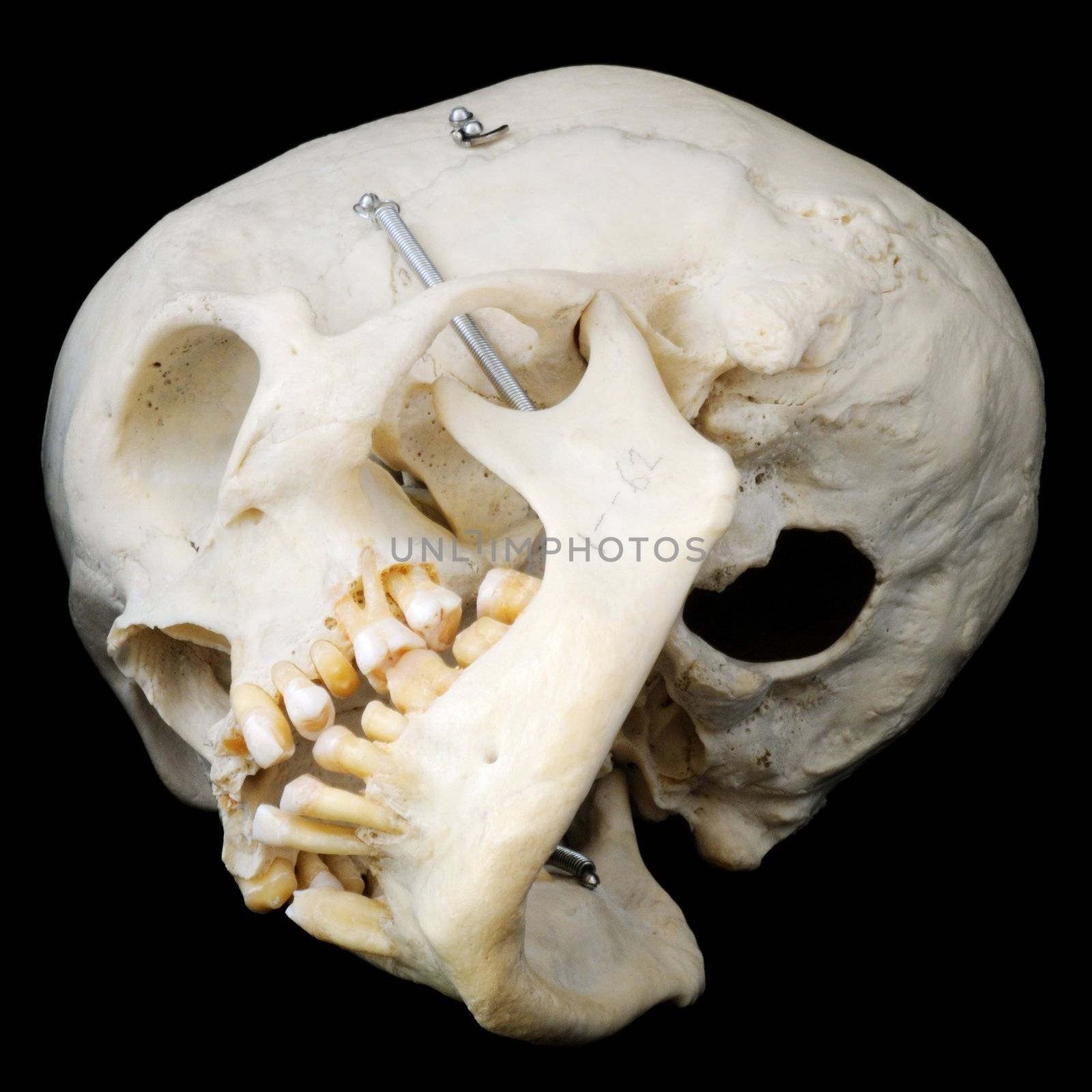 Real human skull with hinged jaw and some missing teeth.  View of underside, with skullcap removed.